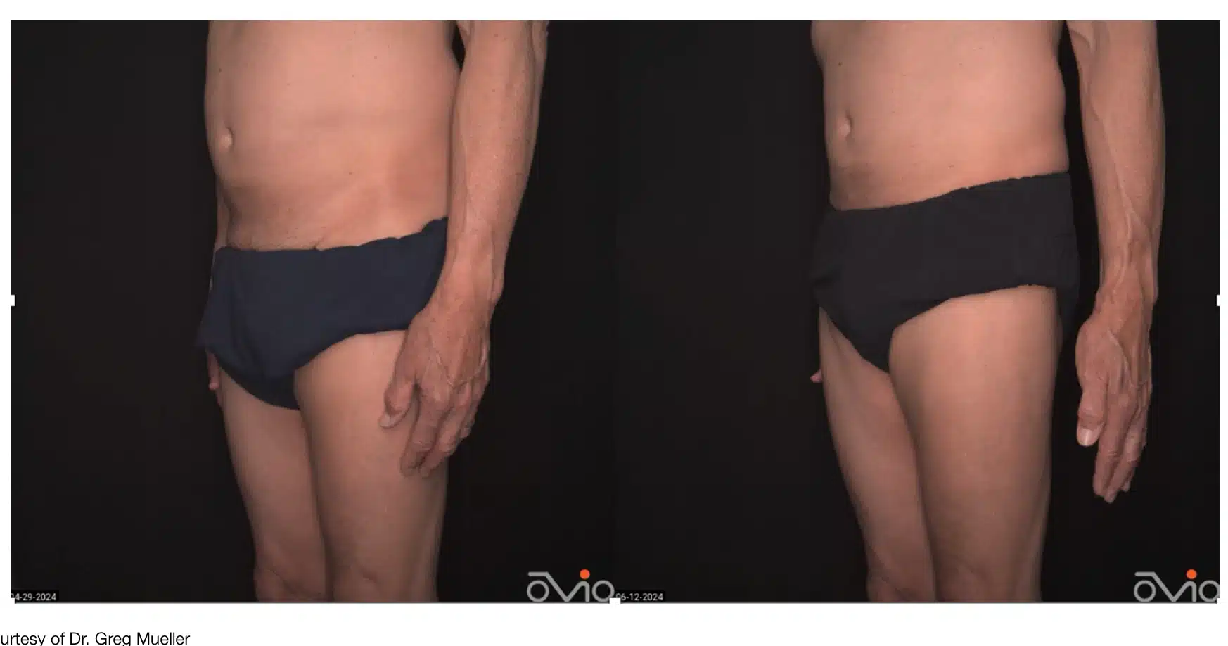 Emsculpt full body Gallery at erickson dermatology