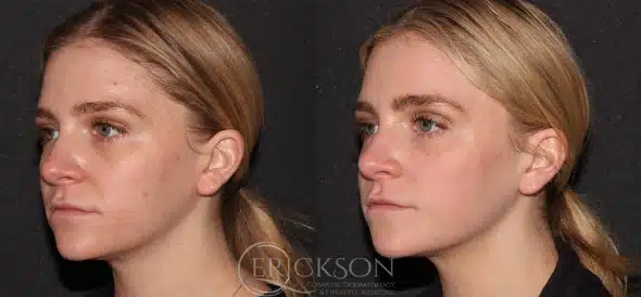 Filler Volume loss of lower face at erickson dermatology